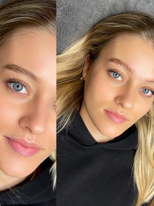 BROWLIFTING